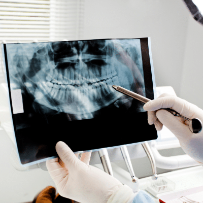 Rvapd the role of pediatric dental x rays blog